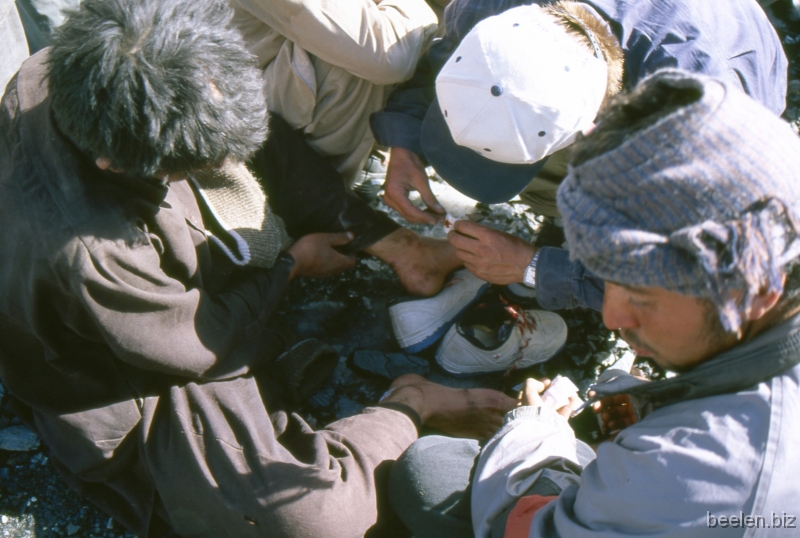 084_Baltoro Blisters Almost all porters suffer nasty blisters on feet and shoulders.
At the end of the day they ask for treatment for their blisters, injuries, head-aches, eyes UV-irritated etc.
They all want treatment first, they all try to draw the doctors attention first, by calling, pulling my arm or shoulder etc.
I lose my temper as they struggle for our attention, I shout at them.
It's a shame.
I carry only half their load, with state-of-the-art gear. 